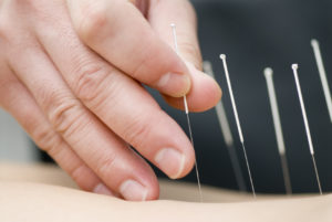 gydymas akupunktura