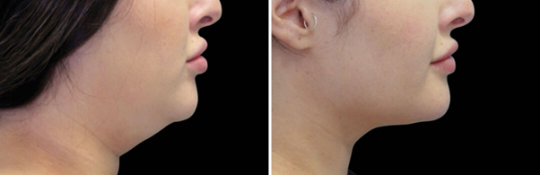 kriotermija pries ir po