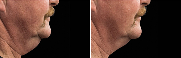 pries ir po kriolipolizes terapijos